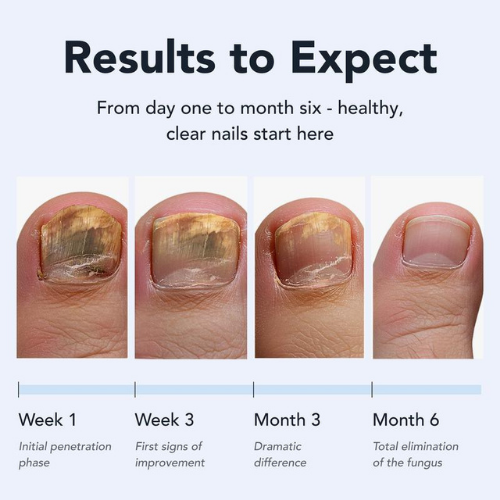 Antifungal Pen For Healthier Nails